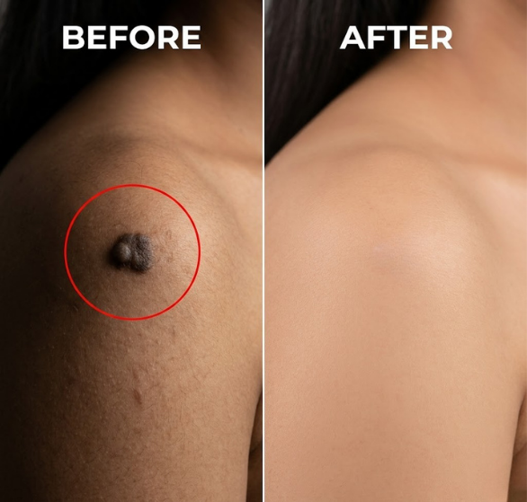 Cryosurgery